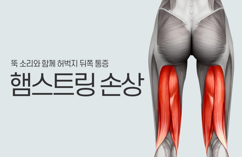 허벅지 뒤쪽 햄스트링의 고통스러운 파열에 주의 6